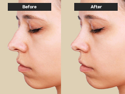RHinoplasty Before After in Islamabad