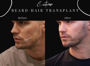 Beard hair transplant before after results