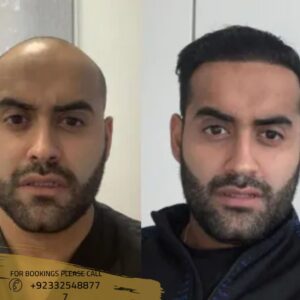 before after results of hair transplant