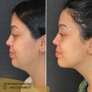Before after of buccal fat removal - ERC 