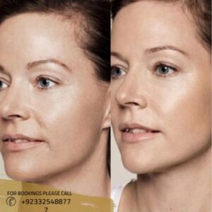 Before after results of volite fillers