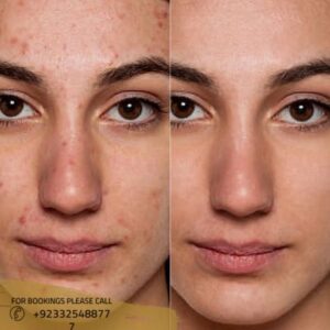 Freckles & Blemishes Removal before after