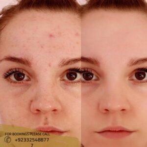 Freckles & Blemishes Removal in Islamabad