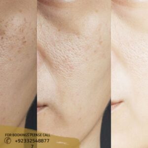 Large Pores Treatment before after results
