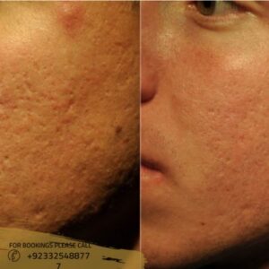 Large Pores Treatment in Islamabad