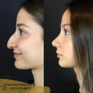Nose tip plasty before after results