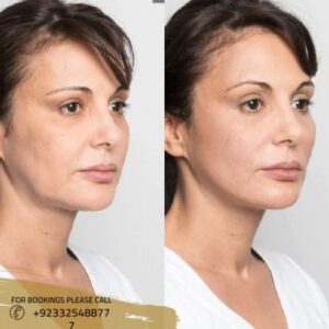 Silhouette facelift in Islamabad