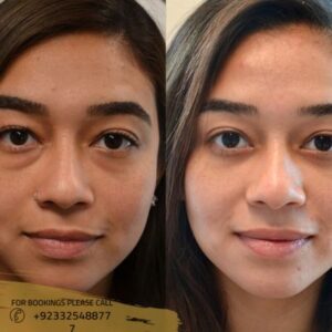 Skin whitening before after results