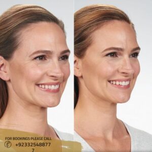 Volite Fillers before after results