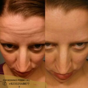 Wrinkle smoothing Treatment results