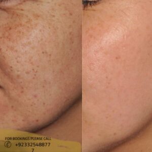 before & after results of Freckles & Blemishes Removal