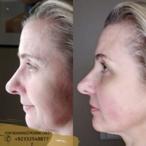 before after results of Hifu treatment