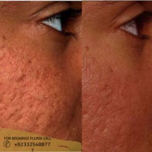 before after results of Large Pores Treatment