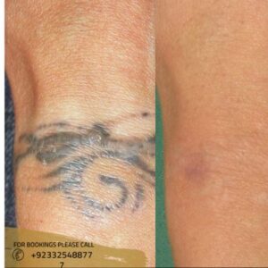 before after results of Laser Tattoo Removal