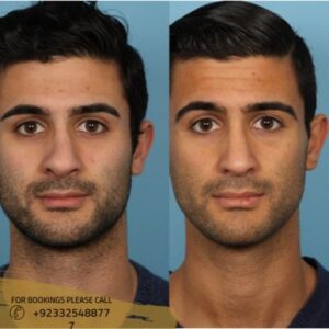before after results of Non surgical rhinoplasty