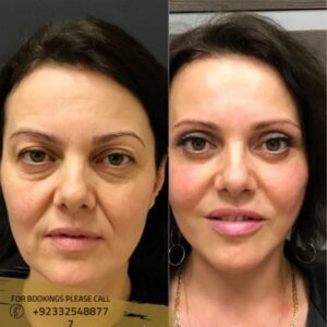 before after results of dermal fillers