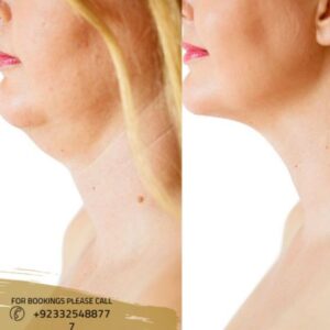 before after results of double chin treatment (1)