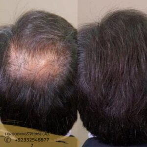 before after results of hair fillers for baldness