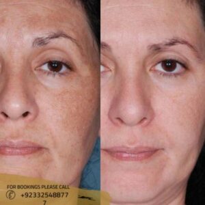 before after results of hyperpigmentation
