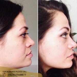 before after results of jaw surgery