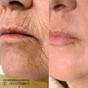 before after results of laser skin tightening