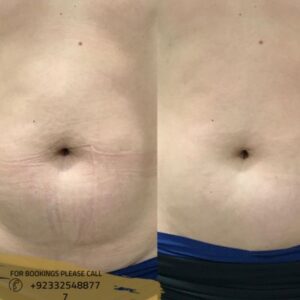 before after results of lipomatic treatment