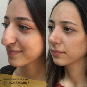 before after results of liquid rhinoplasty