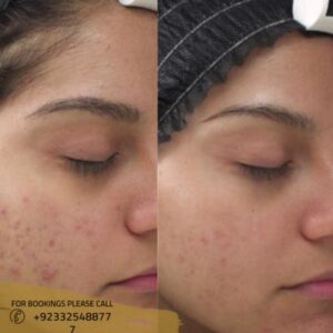 before after results of microneedling Treatment