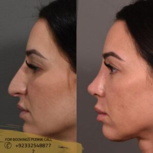 before after results of nose tip plasty - ERC