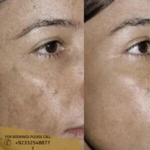 before after results of pico laser treatment