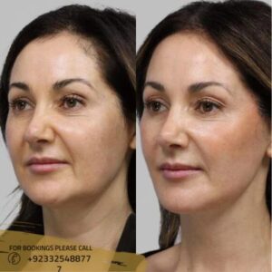 before after results of silhouette facelift