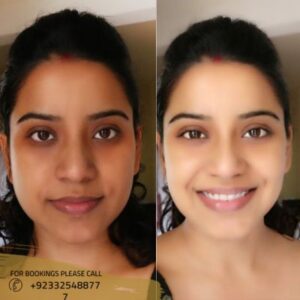 before after results of skin whitening treatment