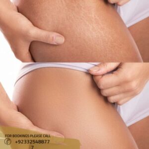 before after results of stretch marks removal