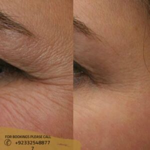 before after results of wrinkle smoothing