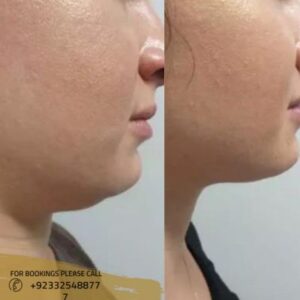 belkyra treatment before after results