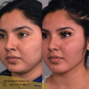 buccal fat removal before after results - ERC (1)