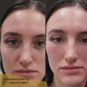 cheek fillers treatment results in islamabad