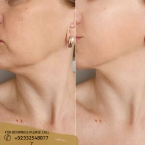 double chin treatment before after results