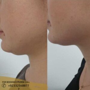 double chin treatment results - ERC