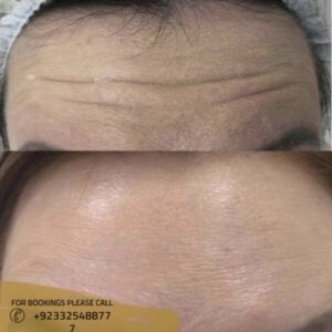 forhead lift treatment in islamabad results