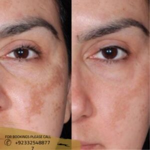 hyperpigmentation treatment before after results