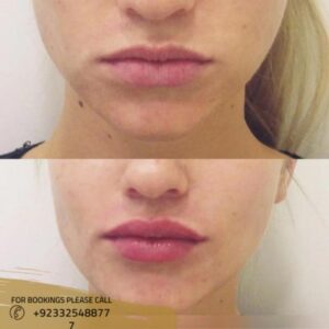lip fillers before after results