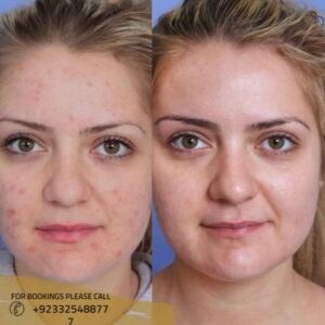 microneedling treatment results