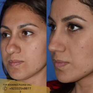nose tip plasty in islamabad results