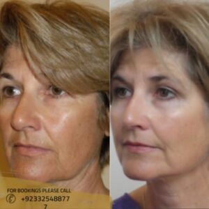 silhouette facelift results - ERC