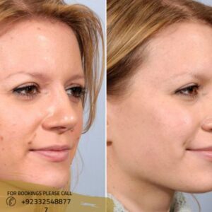 skin tag removal in Islamabad