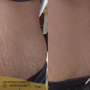 stretch marks removal in islamabad