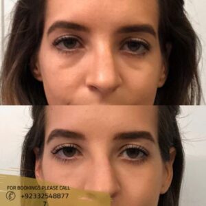 under eyes fillers in Islamabad