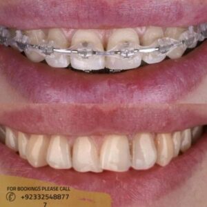 Before after of Dental Braces in Islamabad