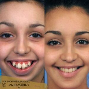 Dental Braces in Islamabad